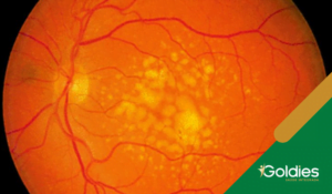 Degeneração Macular Relacionada À Idade (DMRI)